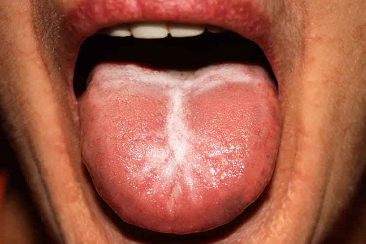 photo of candidiasis in the tongue