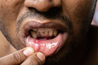photo of  Close up of mouth ulcer 