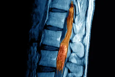 Cauda equina syndrome (CES) happens when spinal nerve roots called the cauda equina become compressed. Surgery is usually needed to prevent serious damage. (Photo Credit: ISM/SOVEREIGN/Medical Images)
