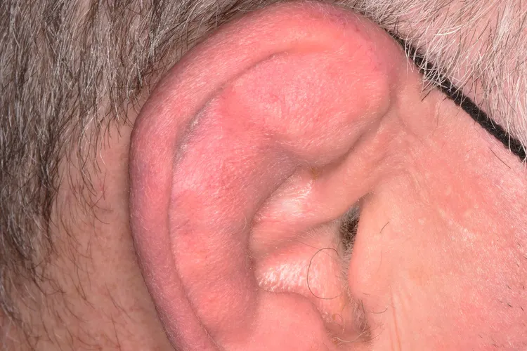 photo of Cauliflower ear