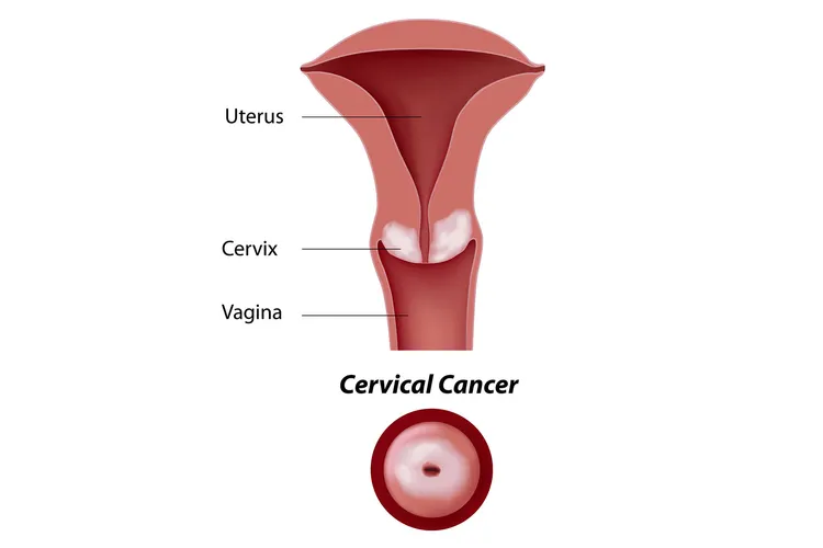 photo of Cervical cancer