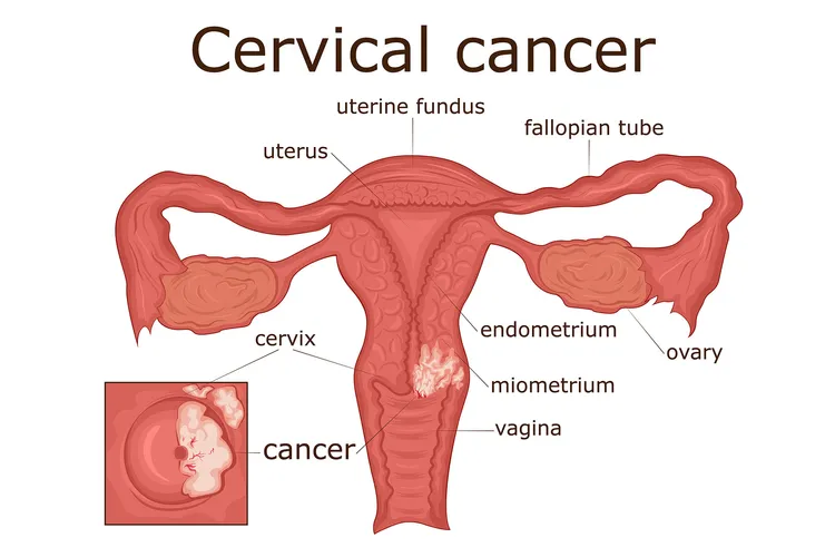 illustration of cervical cancer