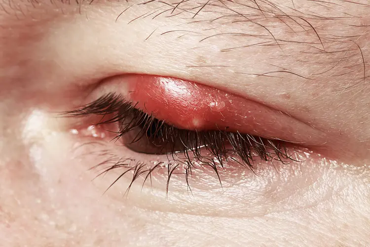photo of Chalazion