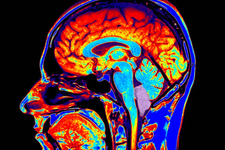 photo of chiari malformation mri