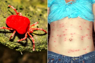 Chiggers are so small that you probably won't see them. Although you'll see (and feel) their itchy bites, they usually don't cause serious harm. (Photo Credit: WebMD Illustration: Dreamstime, Wikimedia Commons).