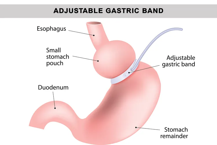 Gastric banding is a reversible weight loss surgery that can help you lose up to 50% of your excess body weight in 2 years. (Photo credit: iStock/Getty Images)