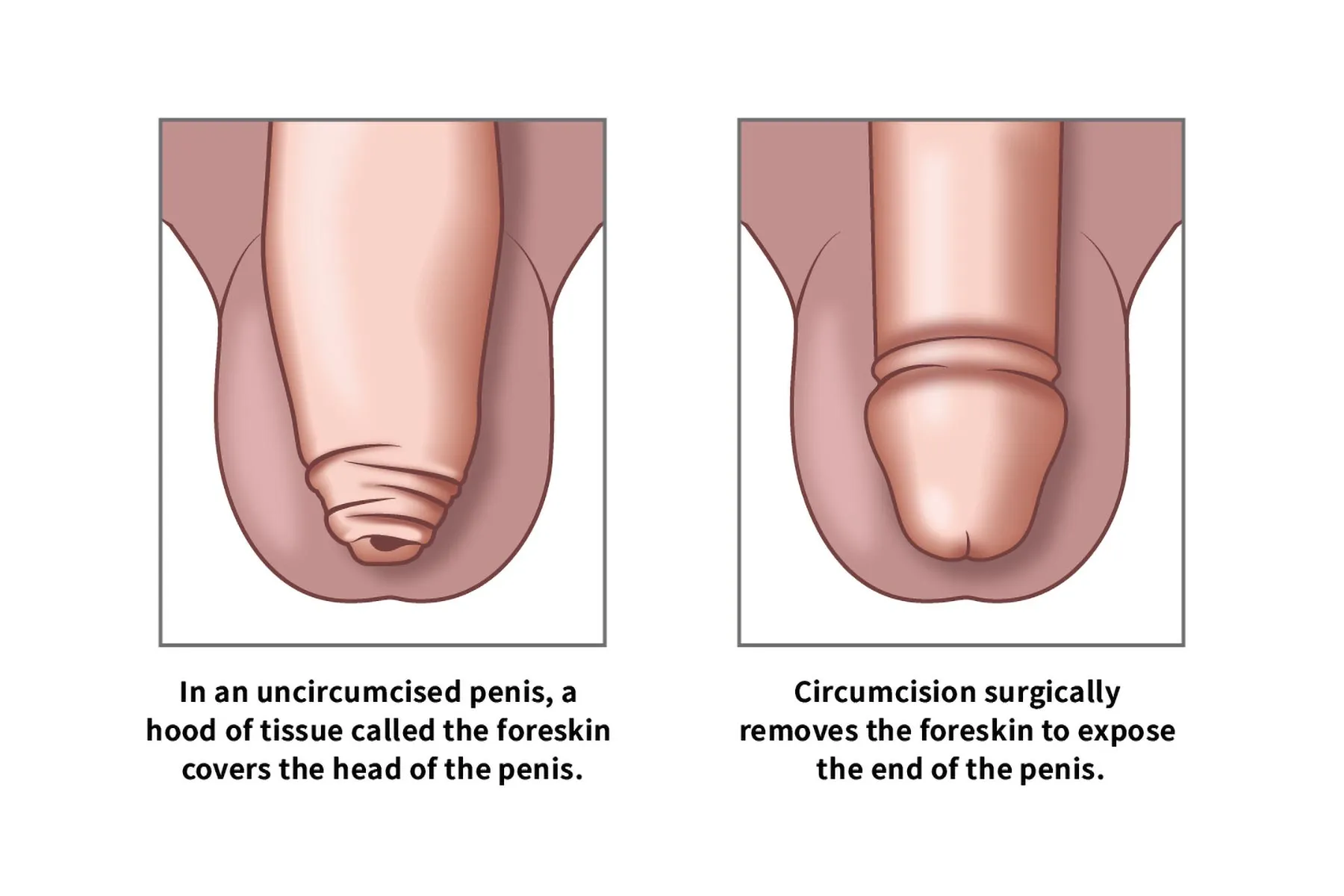 Circumcision: Benefits, Risks, and Procedure