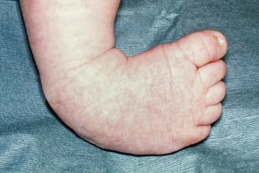 Babies born with clubfoot can usually be treated without surgery. (Photo credit: Central Manchester University Hospitals NHS Foundation Trust, UK/Science Source)