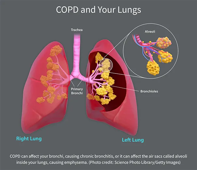 COPD and Your Lungs infographic