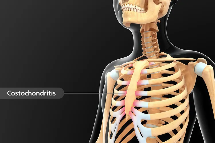 Costochondritis is an inflammation of your costochondral junctions, which are where your ribs attach to your breastbone.  (Photo Credit: Science Photo Library/Getty Images)