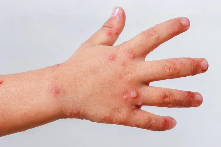 photo of Coxsackie virus infection