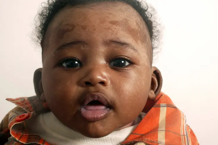 photo of cradle cap
