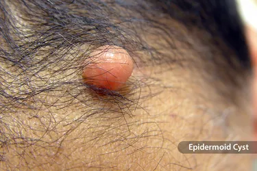 There are a number of conditions that cause lumps and bumps to appear on the surface or just below the skin. Cysts usually do not cause pain unless they rupture or become infected or inflamed. Most cysts do not disappear on their own without treatment. (Photo credit: Scimat/Science Source)