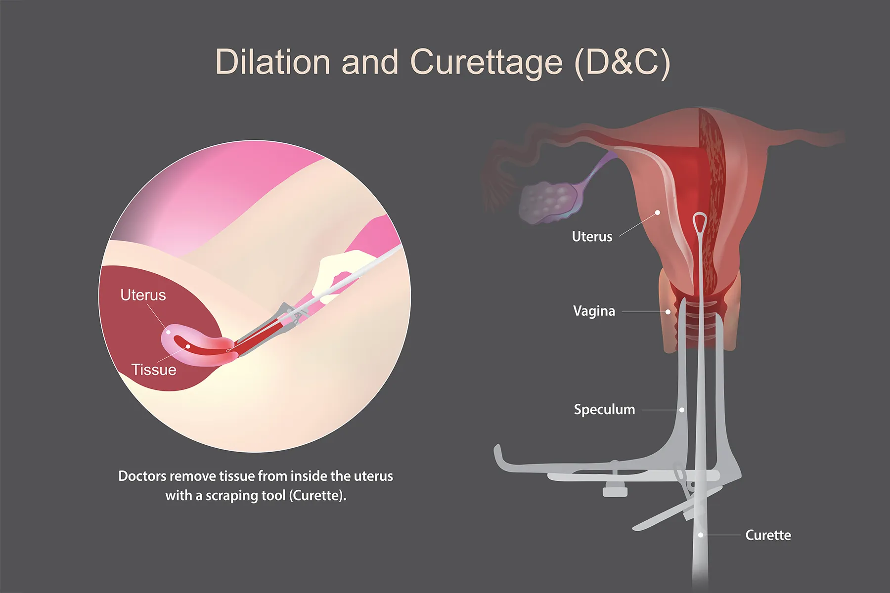 infographic of dilation and curettage procedure