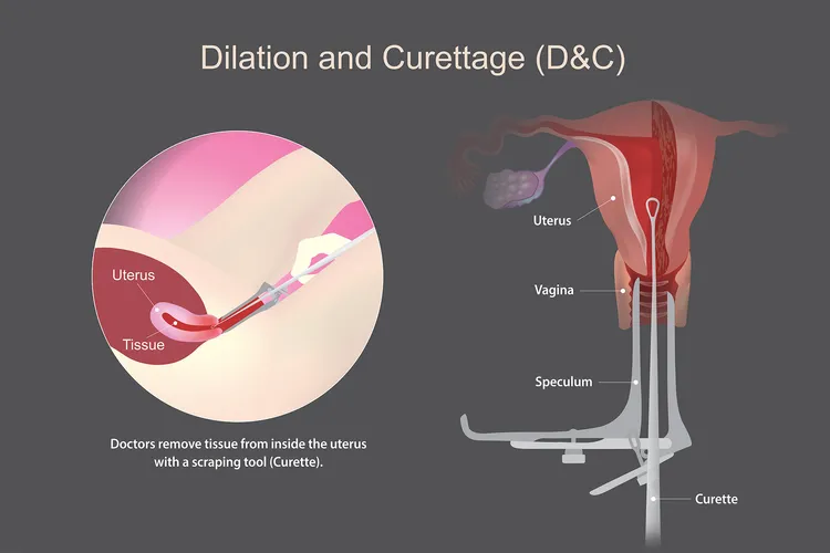 infographic of dilation and curettage procedure