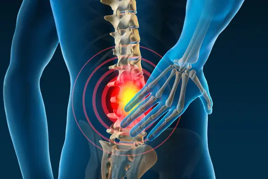 medical illustration of low back pain