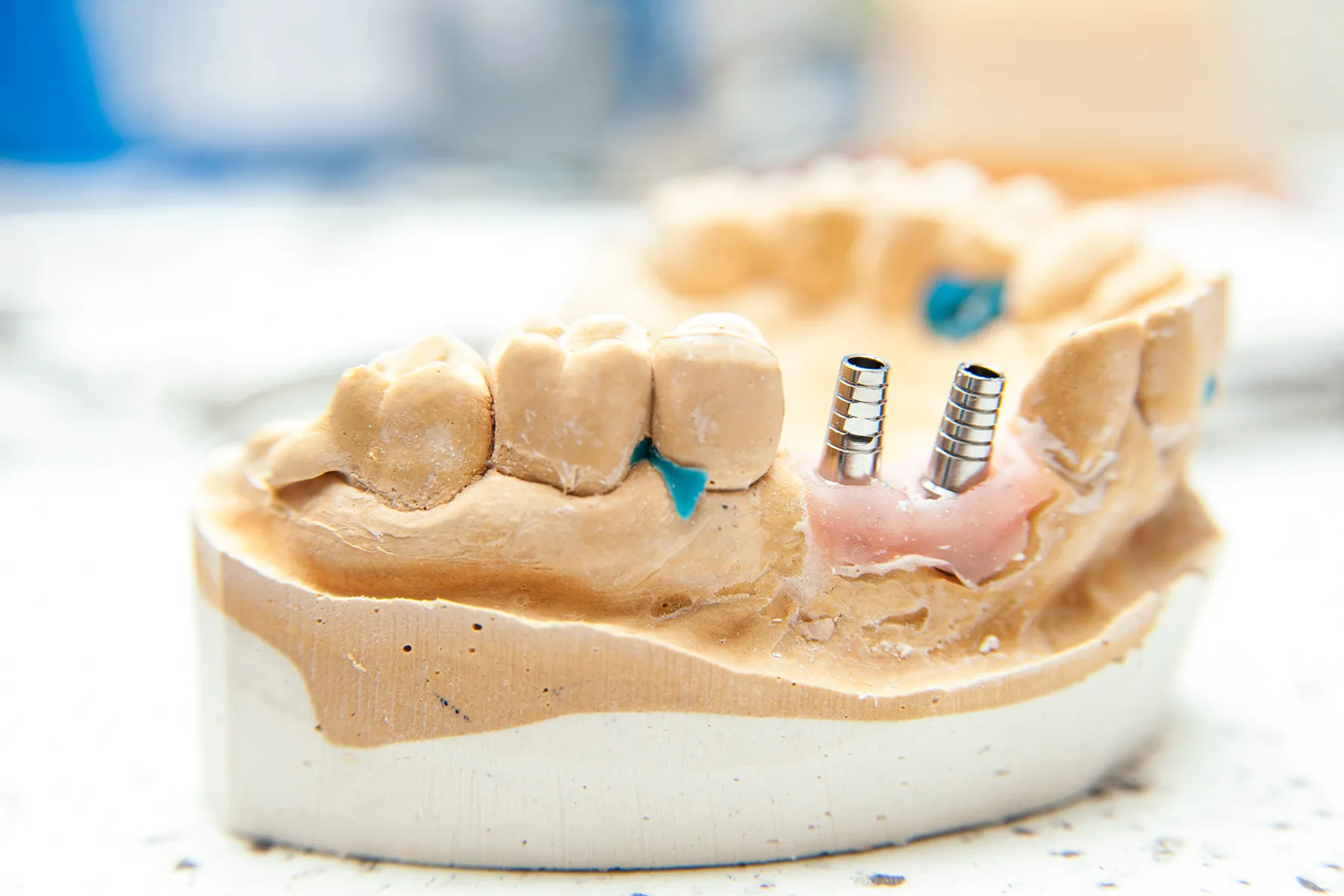 photo of Dental implant model