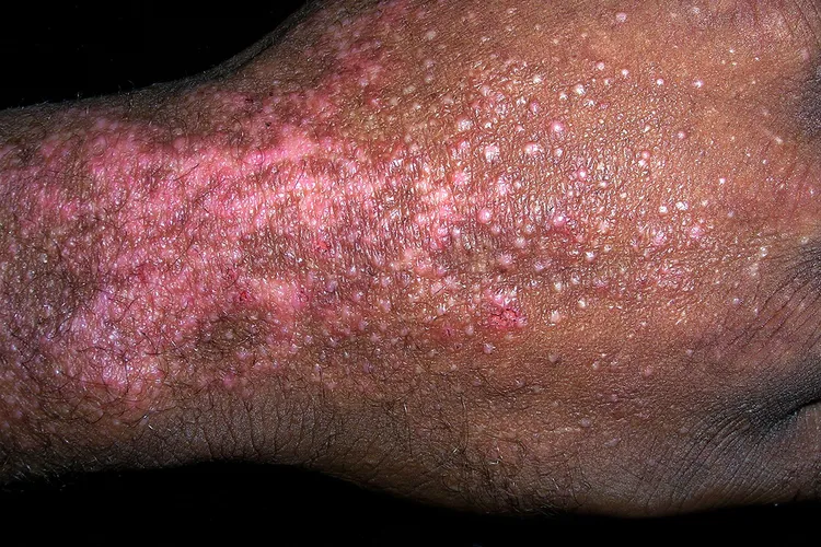 photo of Atopic dermatitis