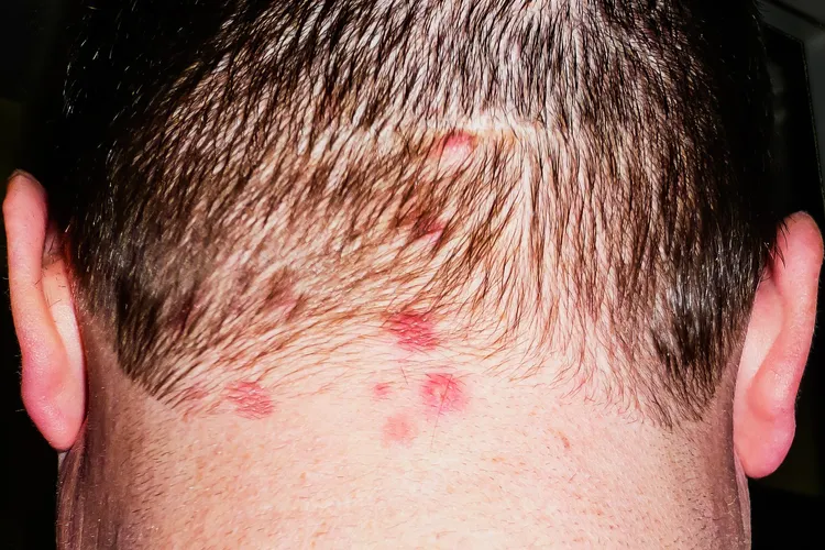 photo of Dermatitis Herpetiformis