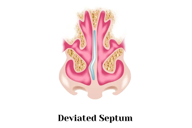 photo of Deviated septum