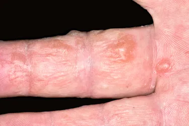 Dyshidrotic eczema causes blisters on your hands and feet as well as other symptoms. While there's no cure, treatment can help manage the condition. (Photo Credit: DR P. MARAZZI/Science Source)