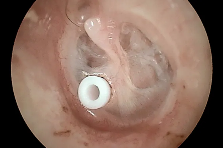 photo of ear tube