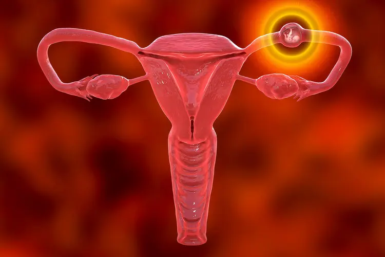 photo of ectopic pregnancy