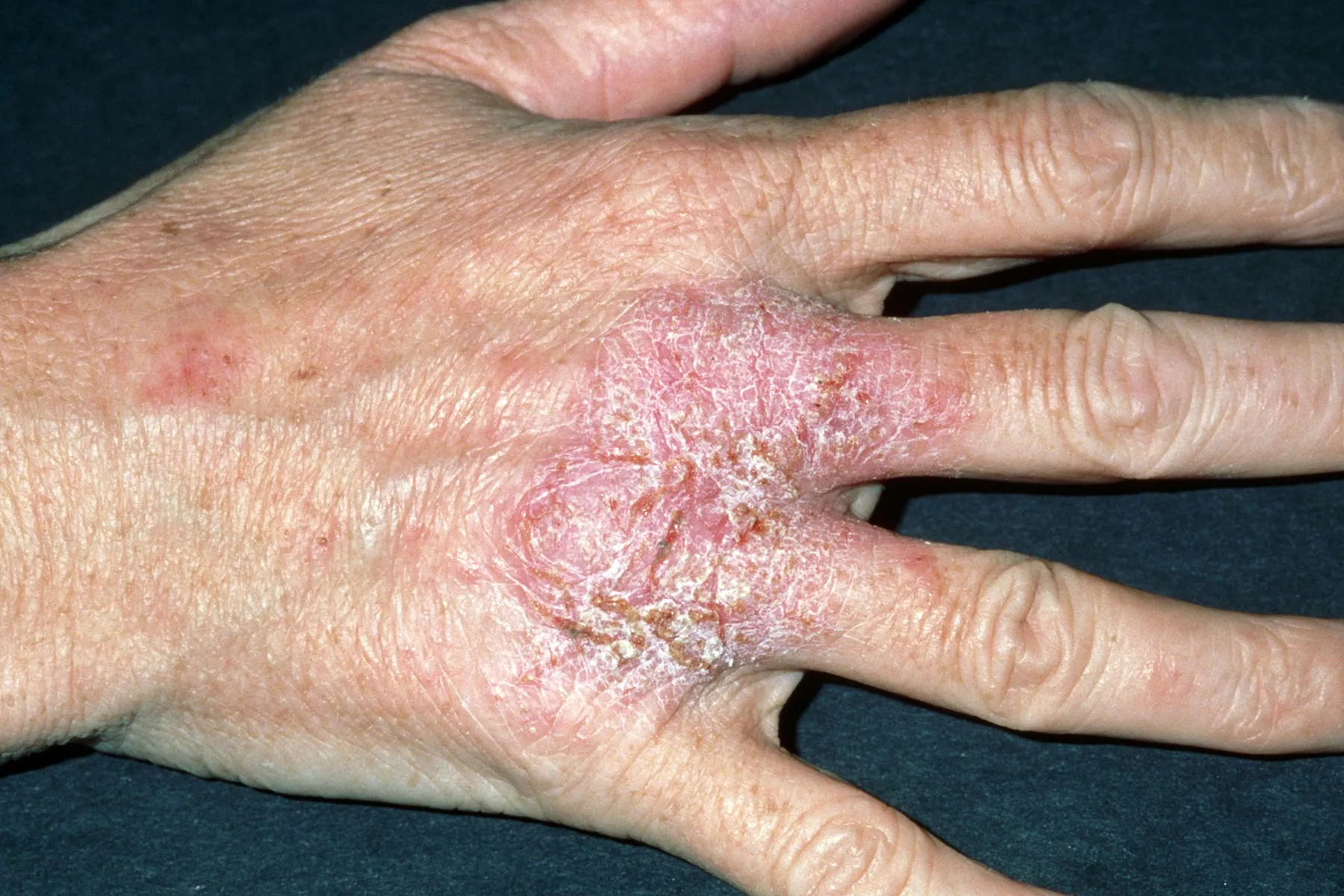 photo of eczema rash on hand