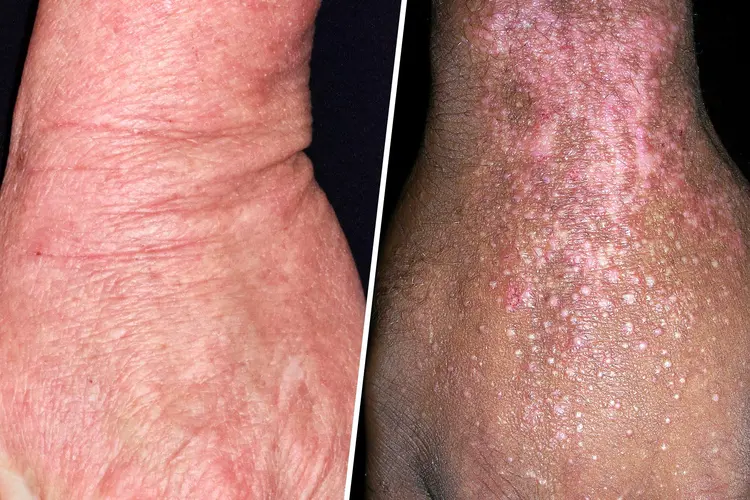 photo of eczema on multiple skin types