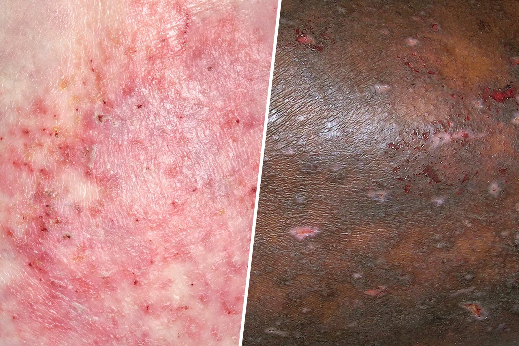 photos of eczema on white skin and skin of color