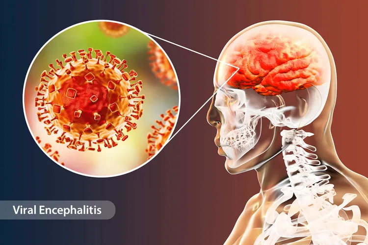 illustration of viral encephalitis