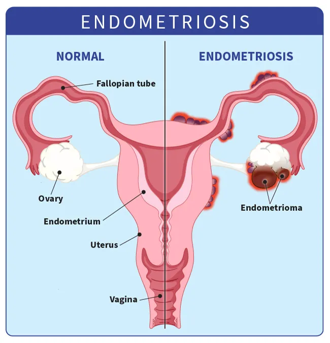 endometriosis infographic