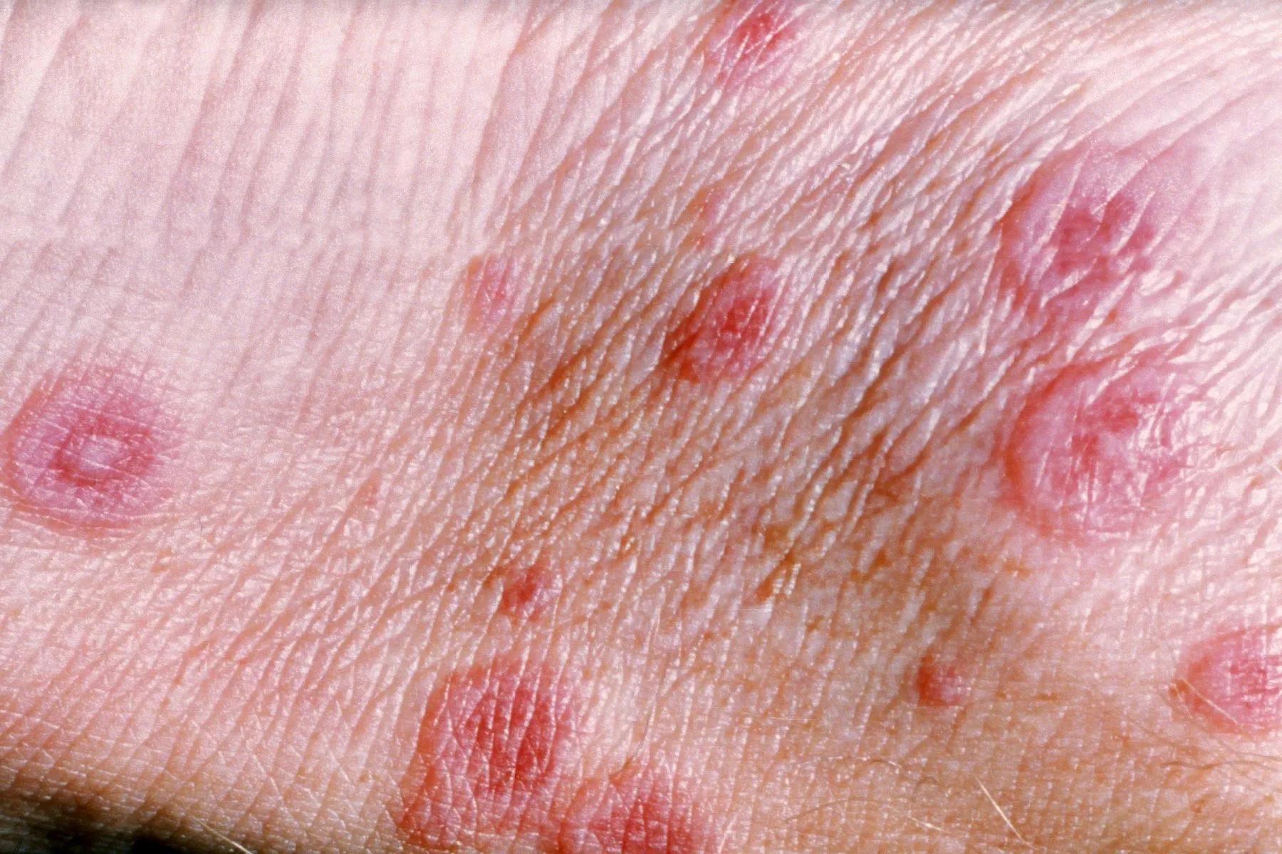 Erythema Multiforme: Treatment, Symptoms, and Causes