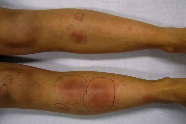 photo of A case of erythema nodosum