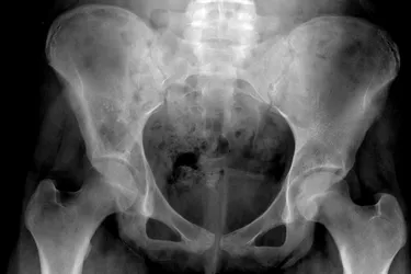Ewing's sarcoma often affects the bones of the pelvis. (Photo credit: Radiopedia)