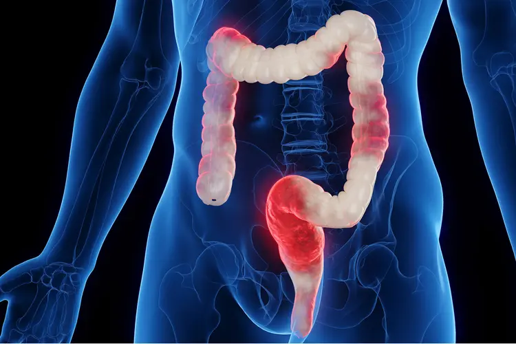 photo of inflamed colon