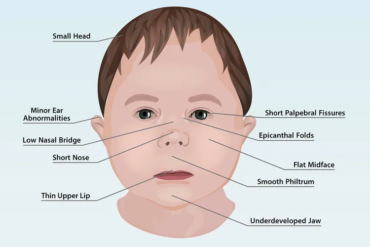 fetal alcohol syndrome infographic