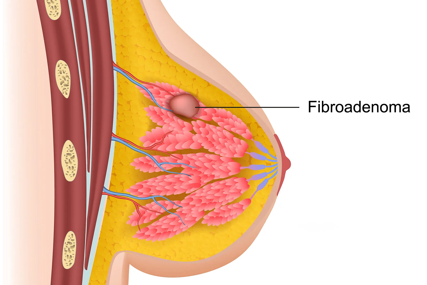 photo of fibroadenoma