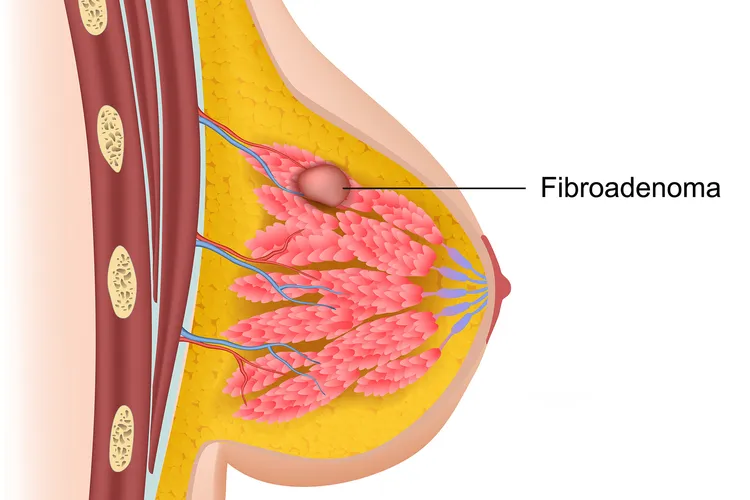 photo of fibroadenoma