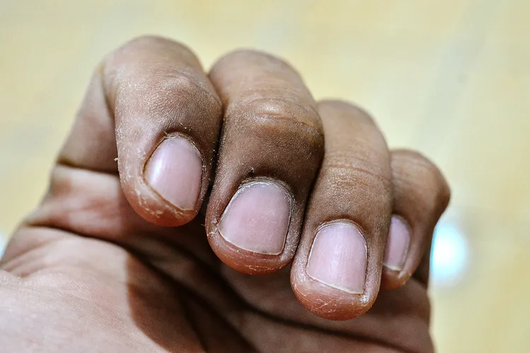 Fingertips Peeling Possible Causes