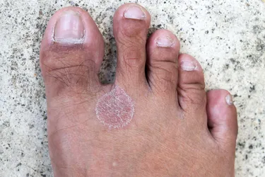 Foot fungus, also known as athlete's foot, is an infection caused by mold. Another name for this contagious condition is tinea pedis. (Photo credit: iStock/Getty Images)