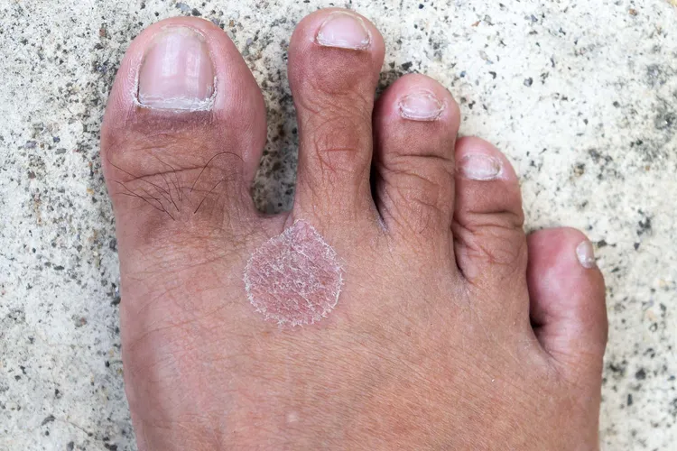 photo of foot fungus