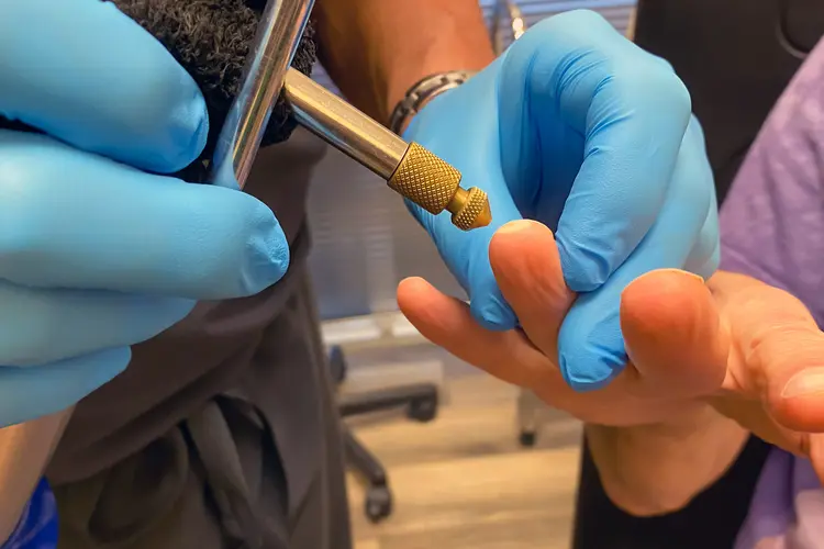 photo of removing wart with cryotherapy