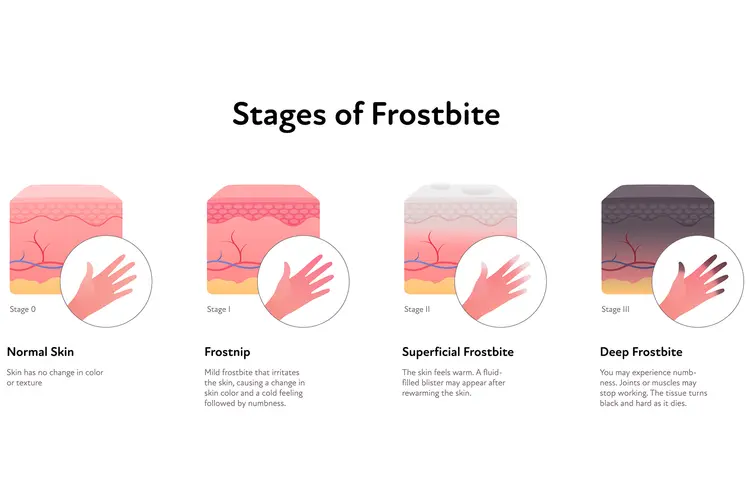 photo of frostbite stages