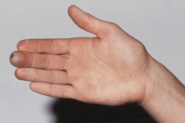 photo of frostbite on finger