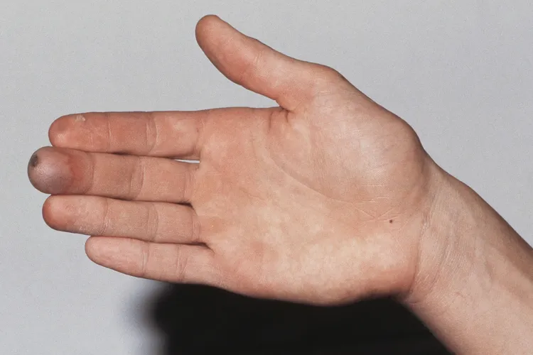 photo of frostbite on finger