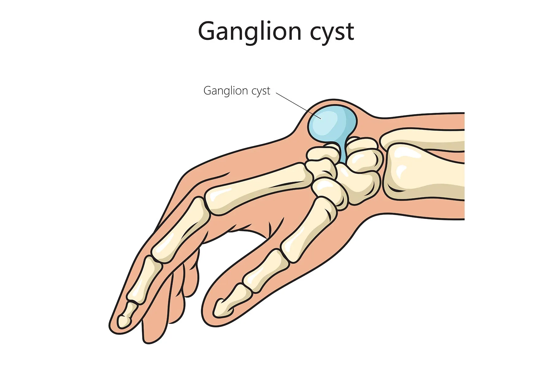 How To Alleviate Ganglion Cyst Pain Infoupdate