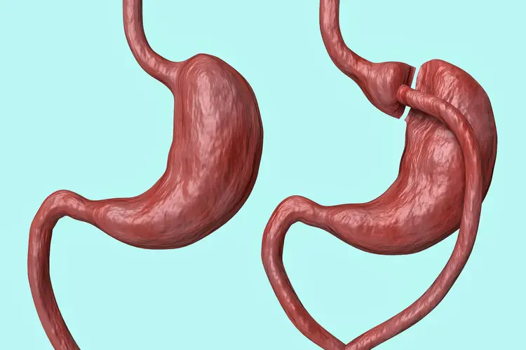 photo of gastric bypass