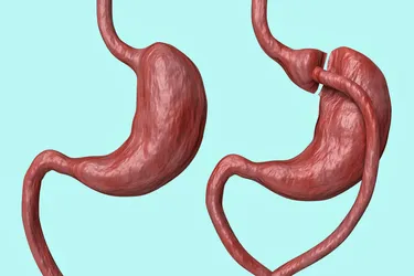 Dumping syndrome is common after gastric bypass surgery, in which all or part of your stomach is removed. (Photo Credit: iStock/Getty Images)