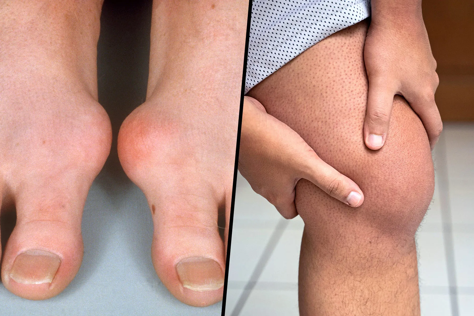 Gout Symptoms: Pain & Swelling in Hands, Knees, Feet & Joints